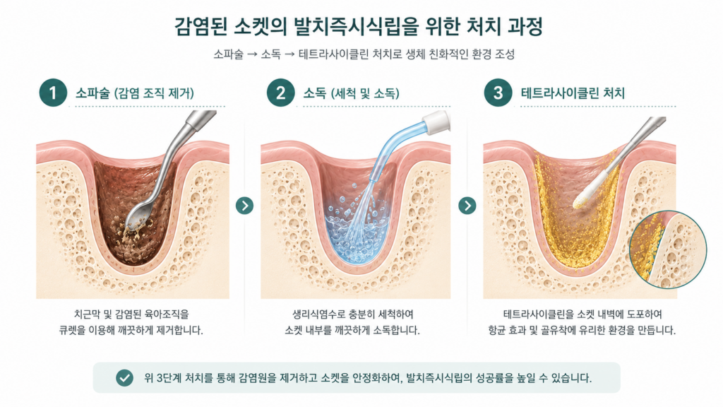 감염 소켓 발치즉시식립 소파술 소독 테트라사이클린 처치 과정