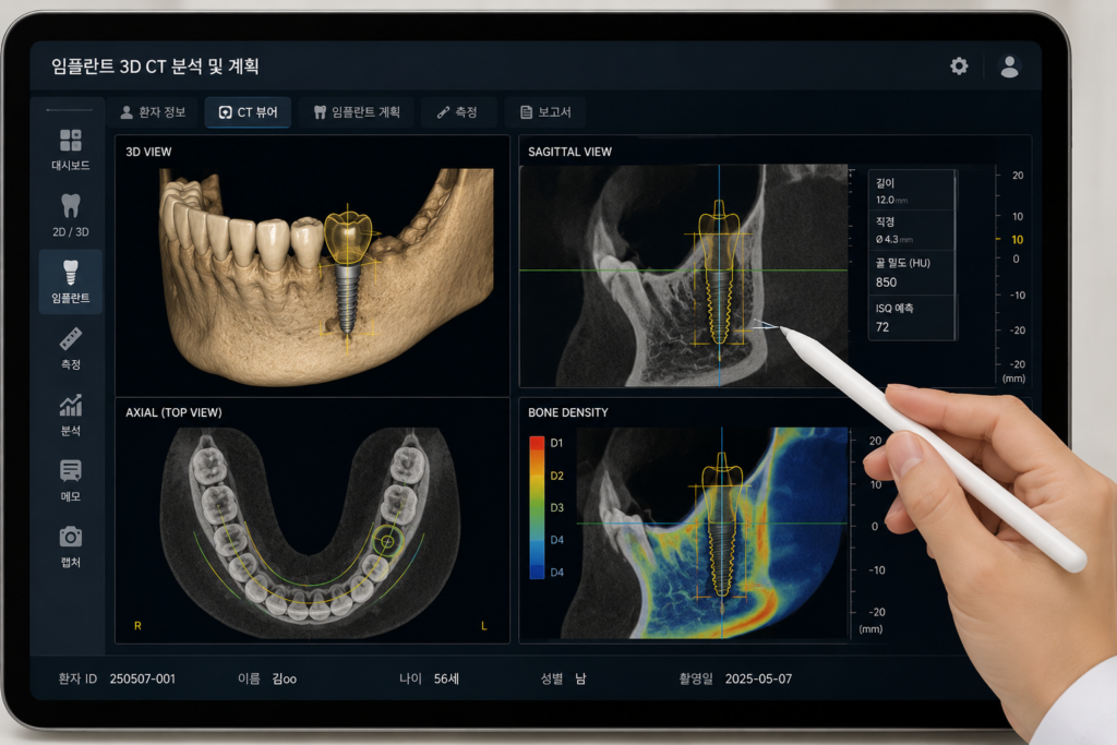 바른모양치과 발치즉시식립 3D CT 사전 설계 성남 임플란트