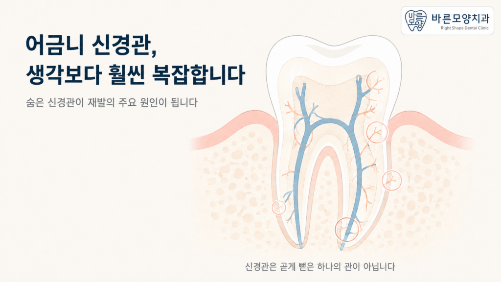어금니 신경관의 복잡한 구조 일러스트 — 신경치료 재발 원인 설명