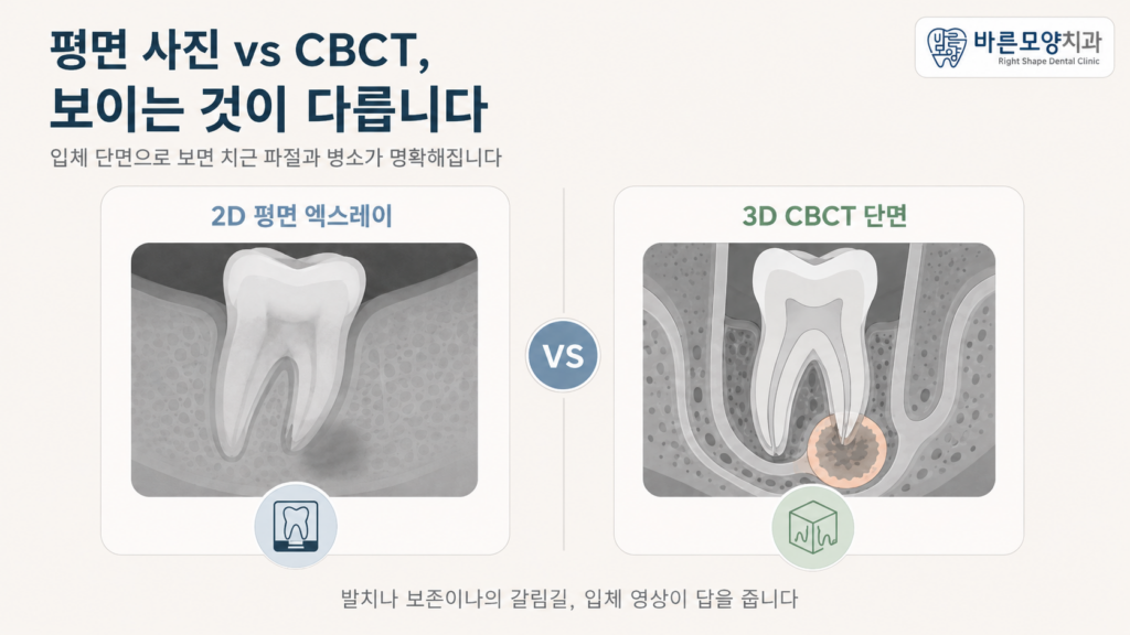 재신경치료 전 CBCT 정밀 진단으로 치근 파절과 치근단 병소를 입체적으로 확인하는 비교 이미지