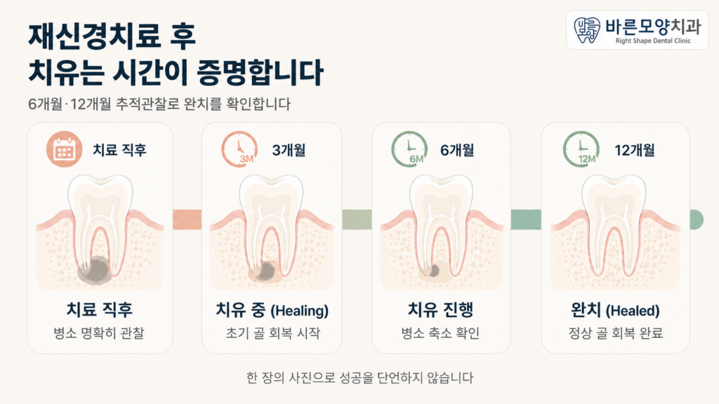 재신경치료 후 치근단 병소 회복 타임라인 — 치유 중에서 완치까지의 추적관찰 단계