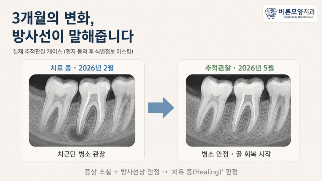 재근관치료 전후 치근단 방사선 비교 — 치근단 병소가 안정되고 골이 회복되는 추적관찰 경과