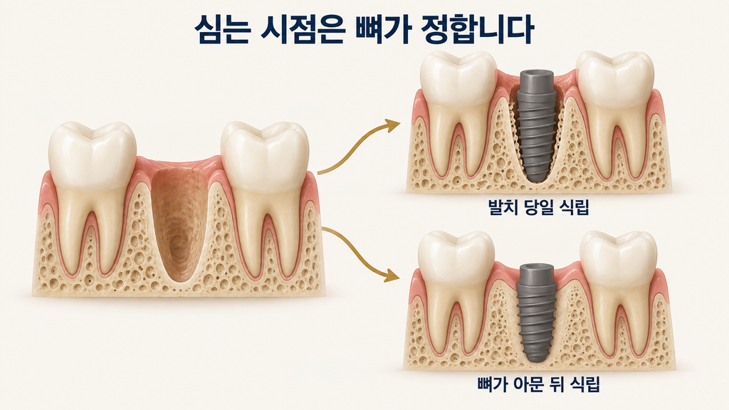 발치 후 임플란트 식립 시기 결정 흐름도 — 초기고정이 가능하고 뼈가 아문 뒤 높이를 예측할 수 있으면 발치 당일 식립하고, 둘 중 하나라도 어려우면 뼈가 충분히 아문 뒤 식립하며, 뼈에 붙은 정도를 ISQ로 확인한 뒤 치아를 올린다